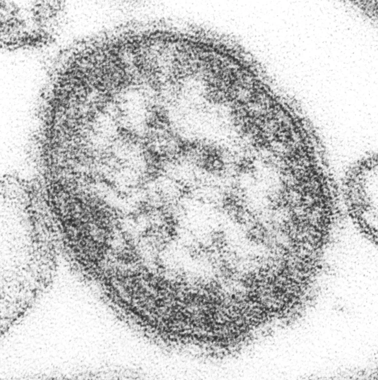 New York declares measles disaster emergency as US cases climb